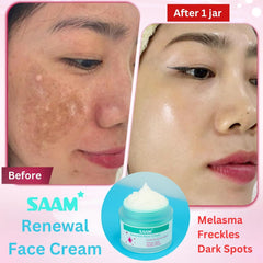 SAAM Renewal Face Cream  Melasma,