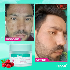 SAAM Renewal Face Cream  Melasma,