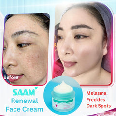 SAAM Renewal Face Cream  Melasma,